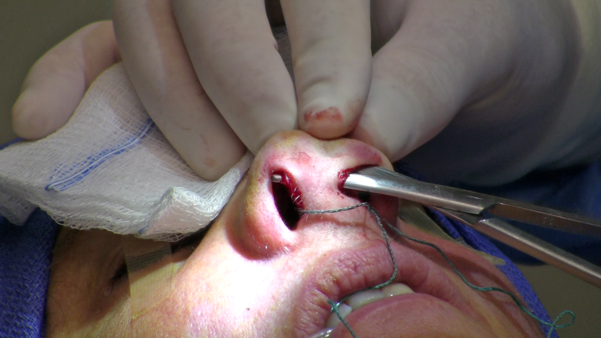 Surgeon Performing Open Rhinoplasty