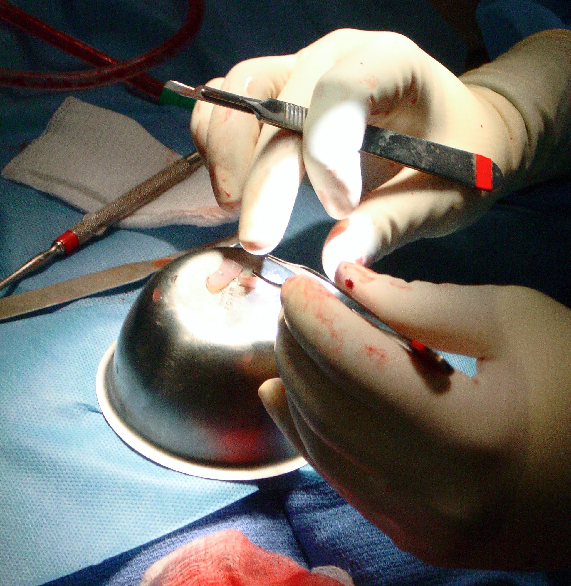 Surgeon Performing Closed Rhinoplasty