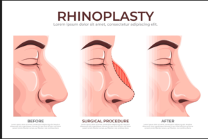 Open VS Closed Rhinoplasty Comparison