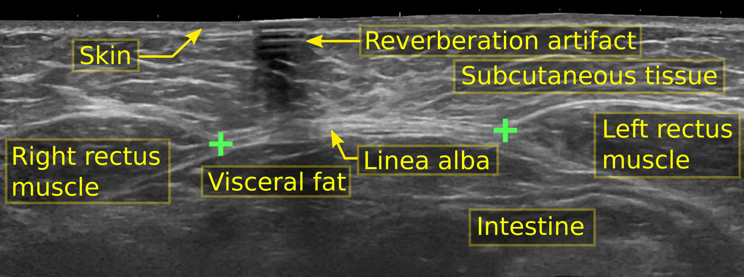 Posição das partes internas da diástase abdominal