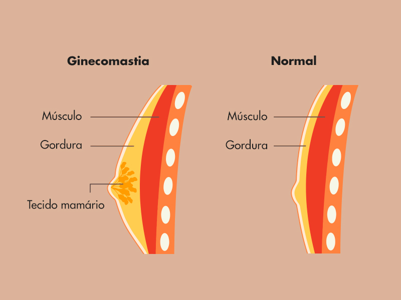 Médico discutindo ginecomastia masculina preço, consulta moderna, gráficos