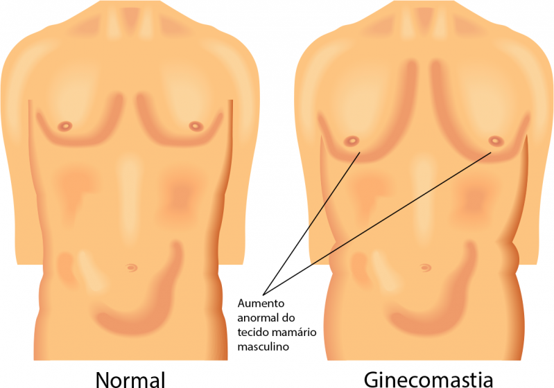 Cirurgião realizando cirurgia de ginecomastia masculina preço, sala estéril, instrumentos precisos