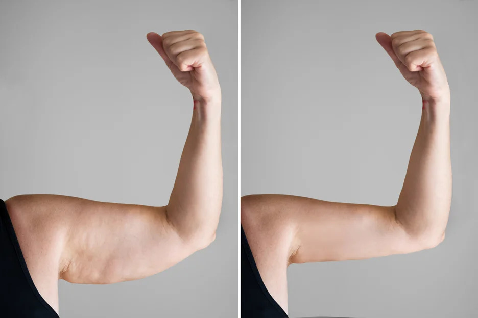 Braquioplastia antes e depois mostrando transformação realista dos braços, de flácidos para firmes