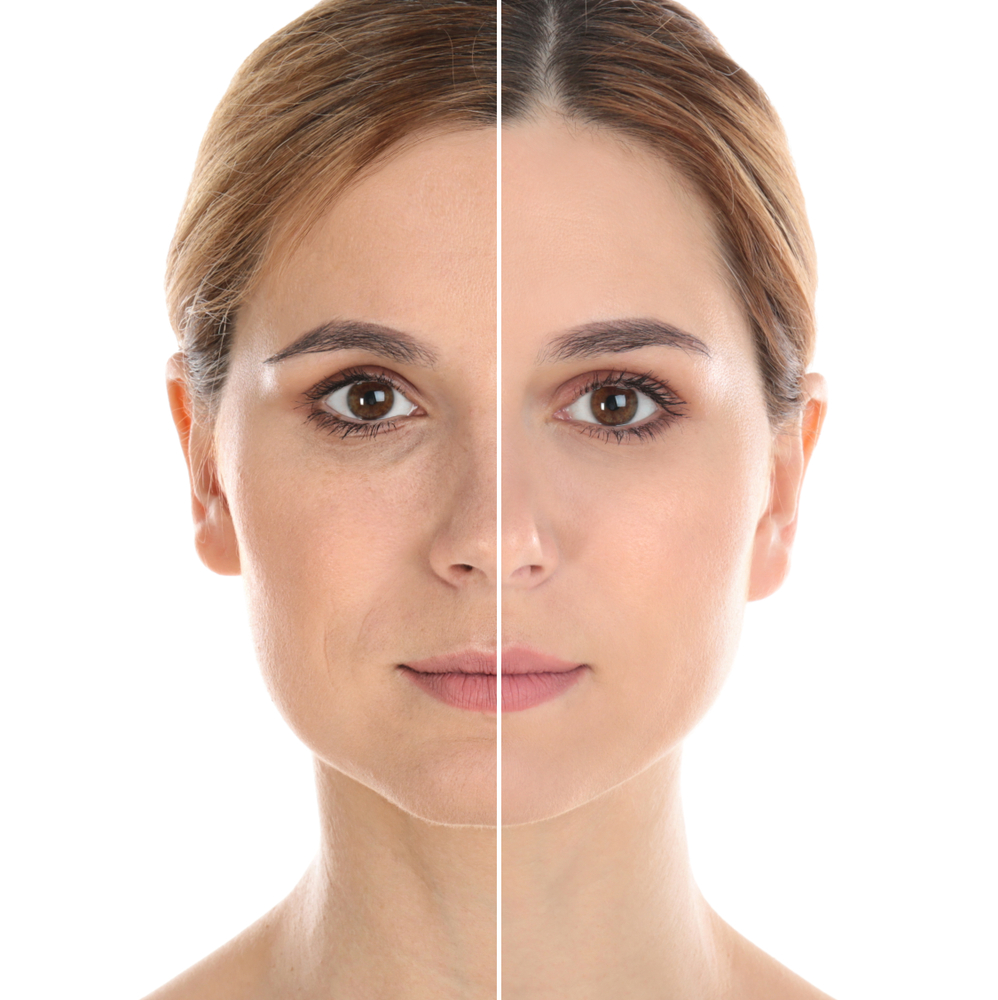 Comparação facial antes e depois de ritidoplastia com fundo surreal, destacando transformação