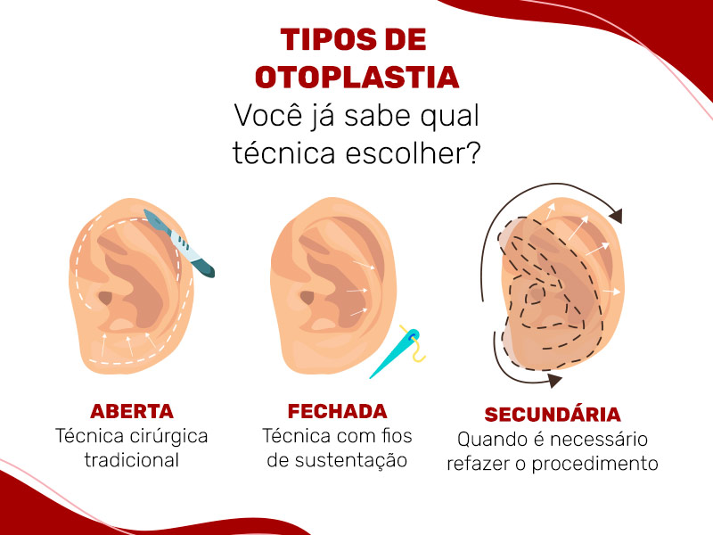 Ilustração em 3 etapas explicando como funciona o procedimento de otoplastia sem corte