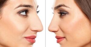 Guia Completo da Rinoplastia Pelo SUS no Rio De Janeiro