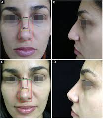 Resultados de Rinoplastia Pelo SUS antes e depois com melhora na respiração e aparência
