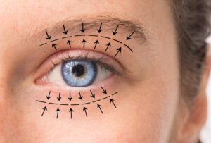 Obtenha o Guia Completo da Blefaroplastia Superior e Seus Benefícios