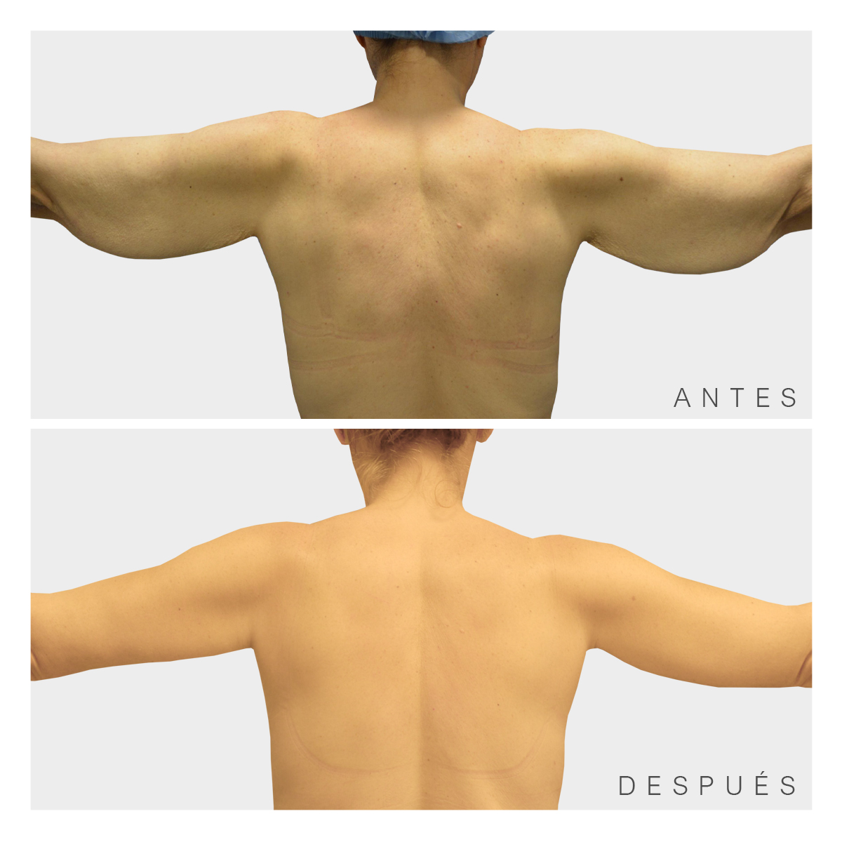 Dermolipectomia Braquial Antes E Depois