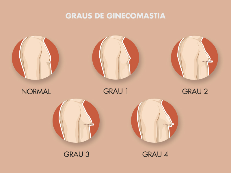 Diferentes graus de ginecomastia