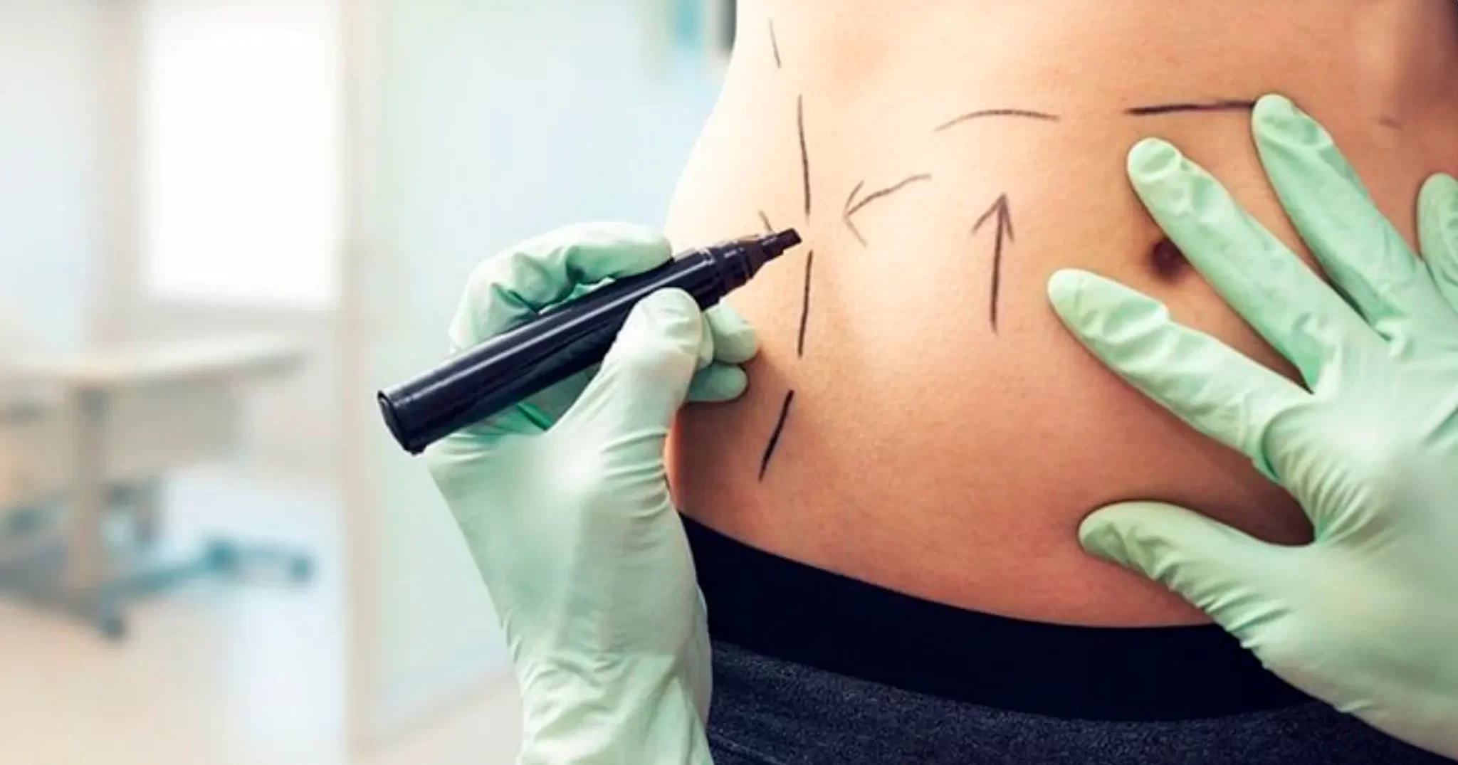 Médico especialista em cirurgia de lipoplastia