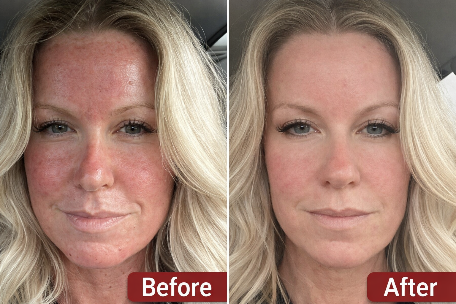 senhora idosa morpheus8 antes e depois