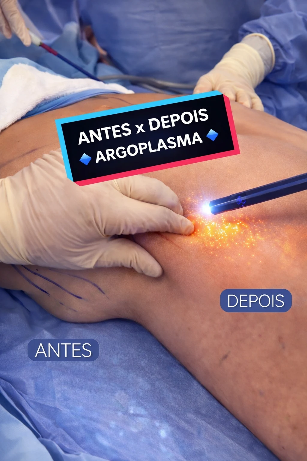 Durante Argoplasma ou Renuvion