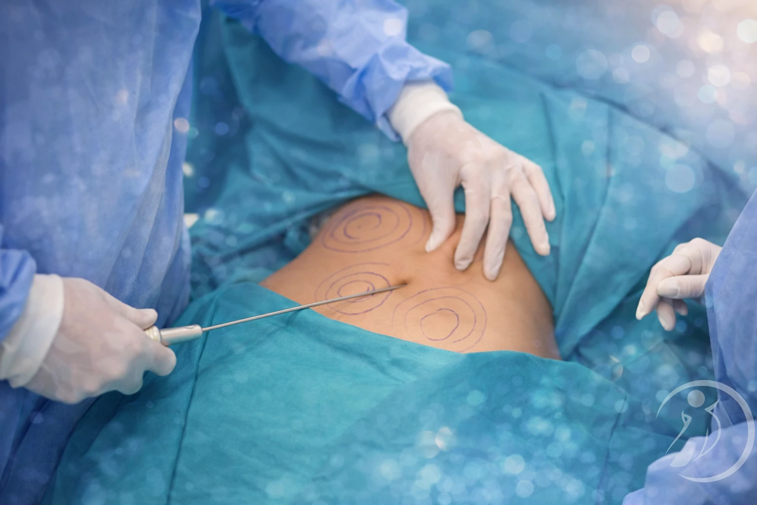 Durante a operação Lipoaspiração na Barriga